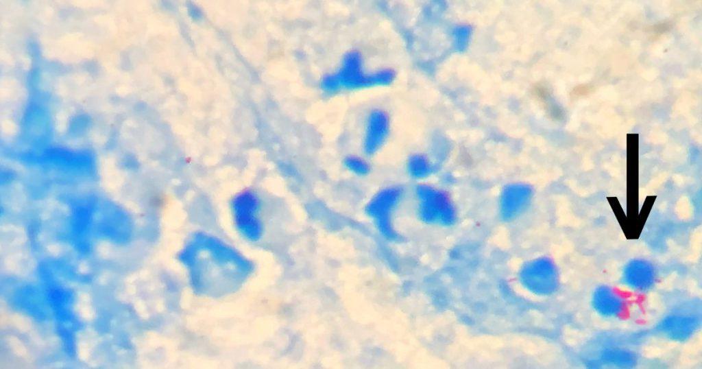 Acid-fast staining (Ziehl-Neelsen, Kinyoun)3